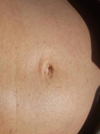 Lichen ruber planus - rady, zkušenosti, jak tišit svědění? - str. 2 - Modrý koník