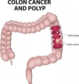 rakovina tlustého střeva a polypy tlustého střeva - adenokarcinom ilustrace stock ilustrace