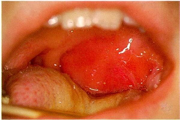 Peritonsillární absces, vlevo