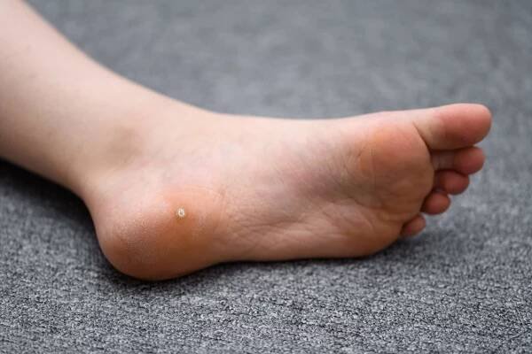 What Are Plantar Warts?