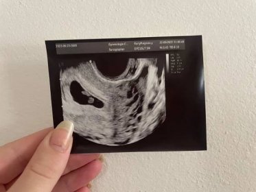 Začátek těhotenství. 2 nebo 1 mimi? - Modrý koník