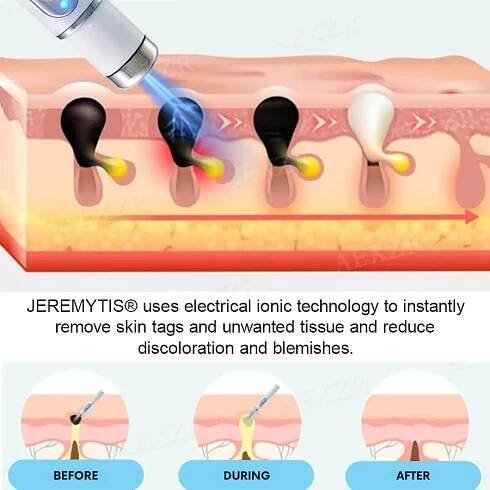 Neinvazivní laserové pero na odstranění znamének a bradavic JEREMYTIS®