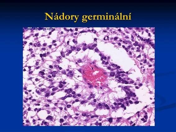 PPT - NÁDORY VARLAT A OVÁRIÍ PowerPoint Presentation, free download - ID:4598887