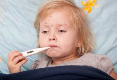 Plané neštovice jsou nejčastějším infekčním onemocněním v České republice. 