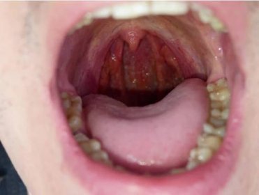 Zubár varuje: Tieto 4 symptómy v ústach neignorujte, značia rakovinu