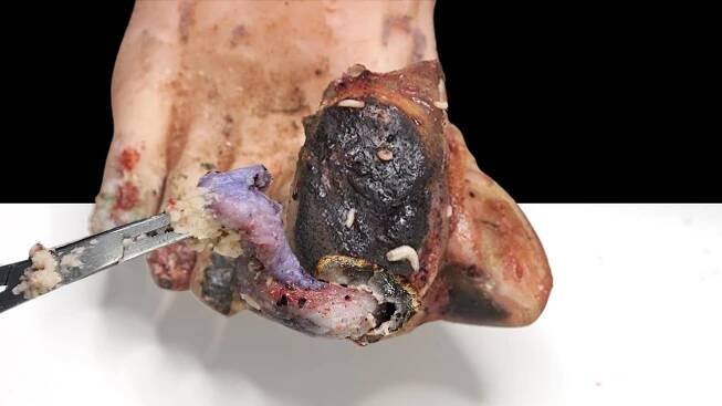 CUT INgrown Toenails, Foreign Body Toenails, Fungal Toenails L2061