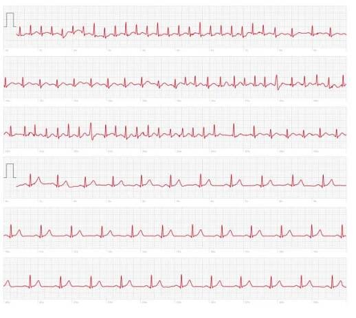ekg ekg elektrokardiogram ukazující fibrilaci síní a supraventrikulární tachykardii následovanou výchozím údajem - flutter síní - stock snímky, obrázky a fotky
