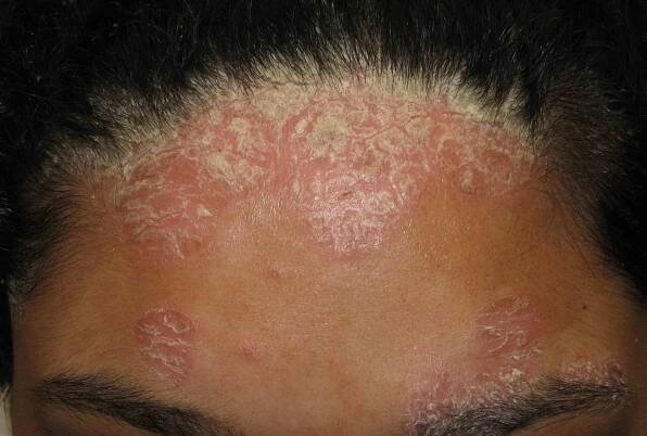 A close up of a rash on a forehead