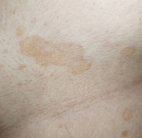 tinea versicolor - pityriasis versicolor - stock snímky, obrázky a fotky