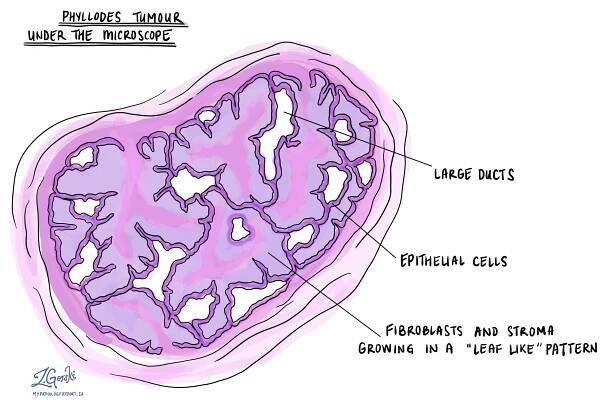 Your pathology report for benign phyllodes tumor of the breast