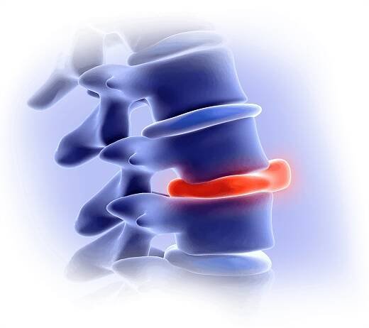 Sciatica and Endometriosis