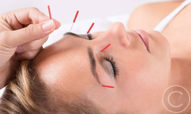 Acupuncture