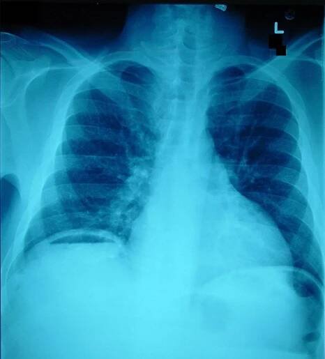 File:Pneumoperitoneum X-ray.jpg - Wikipedia