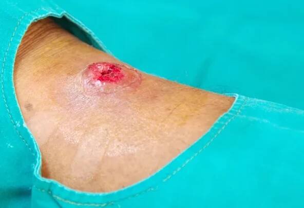 Absces rány — Stock obrázek