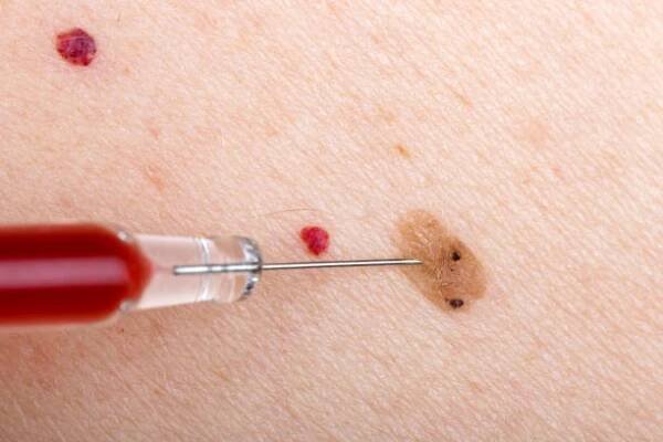 Névus a cherry angioma na lidské kůži — Stock obrázek