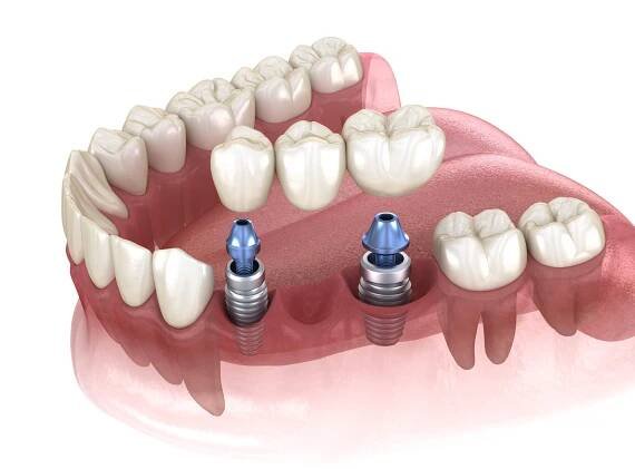 zubní můstek podporovaný implantáty. lékařsky přesná 3d ilustrace lidského zubního a zubního protézy - třenový zub - stock snímky, obrázky a fotky