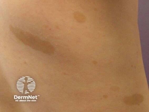 Brown skin lesions – 12 cases