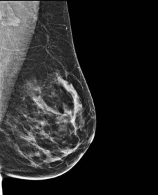 5 věcí, které jste nevěděli o rakovině prsu: Neprozradí ji jen „bulka“!