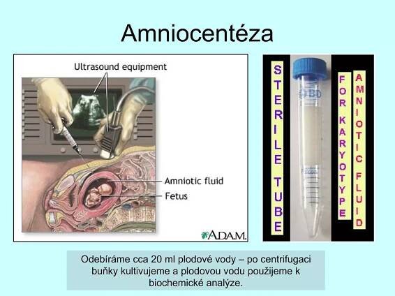 Amniocentéza Odebíráme cca 20 ml plodové vody – po centrifugaci buňky kultivujeme a plodovou vodu použijeme k biochemické analýze. 