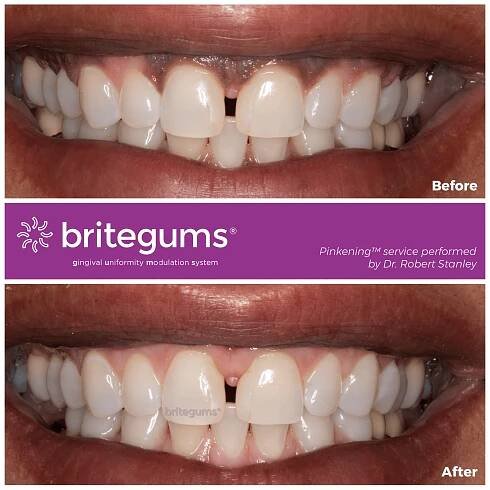the alternative to gum bleaching 03.jpg 768x768