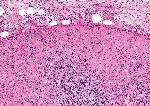 Histiocytic necrotizing lymphadenitis