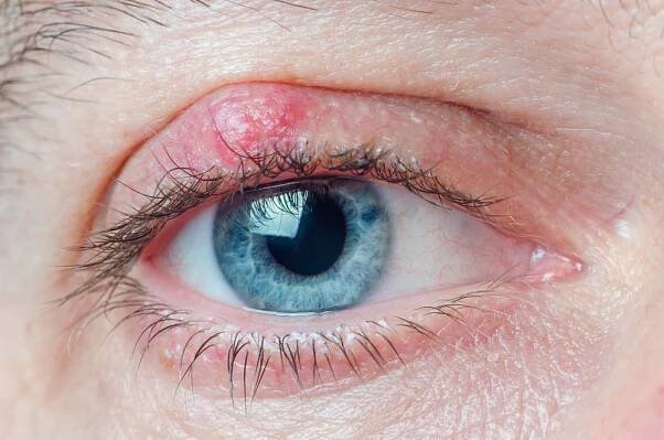 chalazion na víčku muže zblízka - ječné zrno - stock snímky, obrázky a fotky