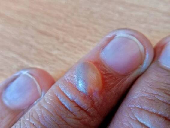 the skin on the fingers blistered due to contact with hot cooking oil - male dermatologist - stock snímky, obrázky a fotky
