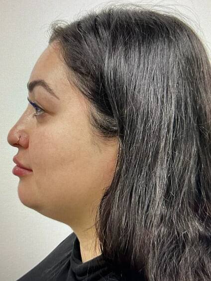 Gallery Dermal Filler