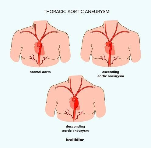 Disekce aorty vs. aneuryzma: Jaký je rozdíl?