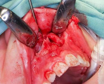 Alternativní transorální přístup pro chirurgické extrakce meziodentů retinovaných na spodině nosní dutiny – LKS časopis