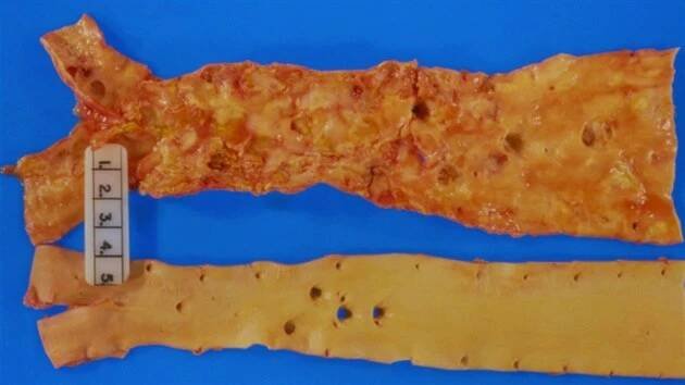 Aorta postižena aterosklerózou (nahoře) a normální aorta (dole).