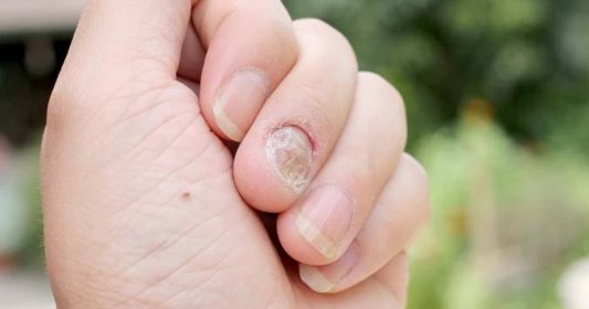 Diagnóza strádajícího těla podle zdravotního stavu nehtů: Rozštěpené, měkké i žluté nehty na něj upozorní