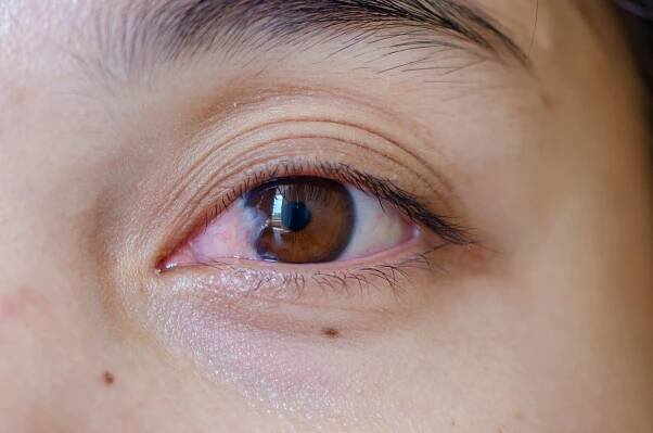 Pterygium & Pinguecula Surgery in Overland Park, KS | Cavanaugh Eye Center
