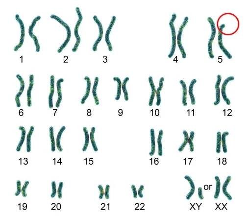 Karyotyp Cri du chat, nebo kočičí pláč, syndrom, označené 3D ilustrace. Vzácná genetická porucha způsobená částečnou chromozomální delecí na chromozomu5. Také známý jako 5p- a Lejeunův syndrom — Stock obrázek