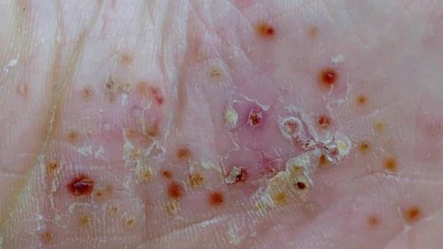 pustular psoriasis on the sole of the foot