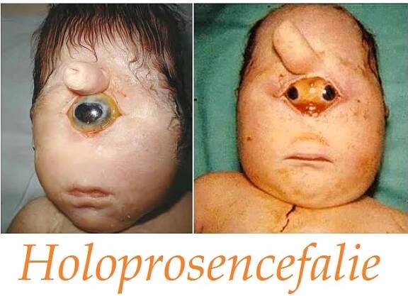 holoprosencefalie priznaky projevy symptomy pricina lecba
