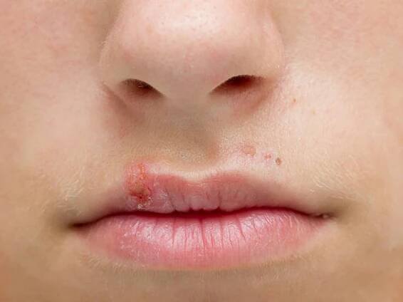 herpes - opary oparech - stock snímky, obrázky a fotky