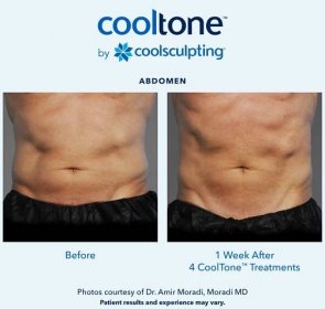 CoolTone™ | FDA Approved Body Contouring | Dermatology SA