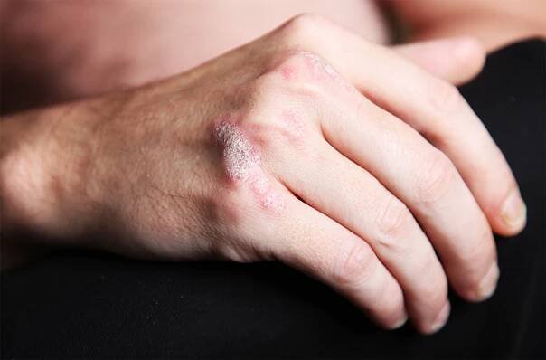 Eine Hand mit typischen Hautveränderungen bei Psoriasis.