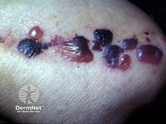 Bullous Pemphigoid: Causes, Symptoms, and Treatment — DermNet