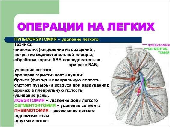 Саркома легких: что это такое, симптомы, лечение, прогноз