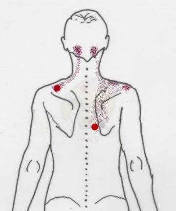 Co jsou spoušťové body (trigger points) a jak je odstraňovat – Regenerační studio