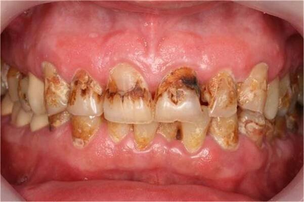 Prosthodontic Treatment 