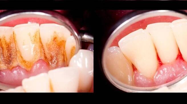 4 Mixtures That Completely Remove Plaque From Your Teeth | Dental health care, Teeth health, Oral health care