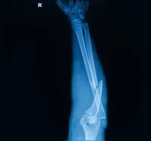 Sbírku lidských rentgeny zobrazeno zlomenina kosti poloměr — Stock obrázek