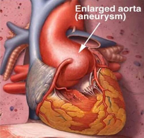 Enlarged Aorta - Symptoms, Treatment, Surgery, Pictures