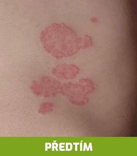 Sorion krém 60 ml – lupénka, ekzém, svědění kůže, psoriáza