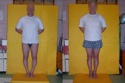 Operative correction of bowed legs or knock knees - photos of patients