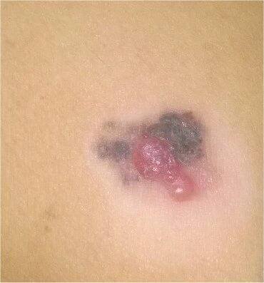 Melanoma (ICD-10: С43) - Online consultation AI dermatologist