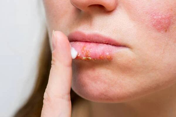 mladá žena s oparem nanášení krému na rty. léčba herpes infekce a viru mastí. selektivní zaměření. - opary oparech - stock snímky, obrázky a fotky